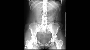 Computed Tomography Of Kidneys Ureters And Bladder Ct Kub