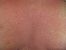 *anaphylaxis is a severe allergic reaction. Anaphylaxis Wikipedia
