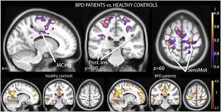 Mirror Neuron Activations In Encoding Of Psychic Pain In Borderline Personality Disorder Sciencedirect