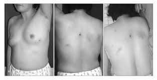 Image result for zoster under breasts