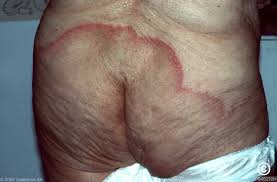 Image result for sore skin in the groin area