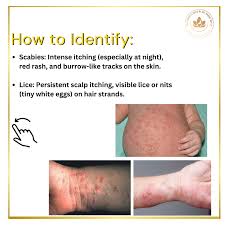 Image result for scabies bite