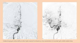 The most reliable test is called a diagnostic cerebral angiogram. Innovations In Acute Ischaemic Stroke Ais Intervention Singhealth