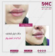 حالتان فيلر للشفايف رسم وكنتور وتعبئة الشفاه بدقه متناهيه لدى دكتورة تسنيم سعد lip fillers lips movie posters