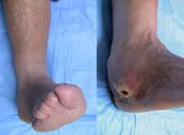 Image result for toe black diabetes
