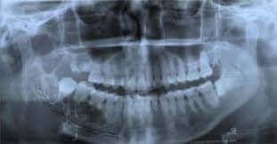 Read about bone cancer prognosis, treatment, symptoms, signs, survival rate, types, metastatic, and stage 4 medicinenet does not provide medical advice, diagnosis or treatment. Oral Cancer Treatment Fort Lauderdale Oral Cyst Removal South Florida