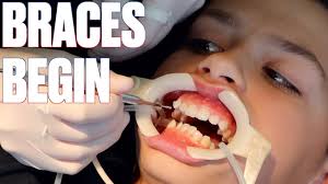Oral anesthetics desensitize your teeth and gums so you don't feel the discomfort of shifting teeth so acutely. Getting Braces For The First Time How To Shorten Time With Braces By Six Months Youtube