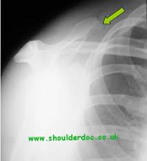 Image result for Snapping Scapula