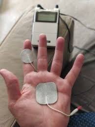 Tens Unit For Trigger Finger Trigger Finger Treatment