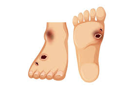 Stopa cukrzycowa patogeneza owrzodzenia neuropatycznego. Stopa Cukrzycowa Przyczyny Objawy Leczenie Cukrzyca Polki Pl