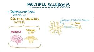 Multiple sclerosis (ms) is a relatively common acquired chronic relapsing demyelinating disease involving the central nervous system, and is the second most common cause of neurological impairment in young adults, after trauma 19.characteristically, and by definition, multiple sclerosis is disseminated not only in space (i.e. Multiple Sclerosis Video Explanation Osmosis