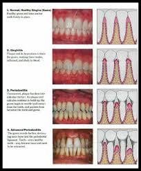 Teeth Gums Diagram Catalogue Of Schemas