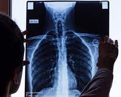 Talc is a very popular product that is found as an ingredient in personal products like baby powder and soap, in electronics, in ceramics, as a precision machinery industrial lubricant, and more. Talc Pleurodesis Surgery For Malignant Plural Mesothelioma Treatment Rmq