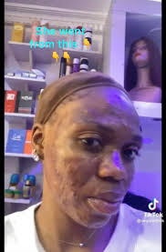 What are these? It appears one or two at a time and leaves a scar. Can  anyone suggest a cure and a way to remove the scar. Thanks in advance