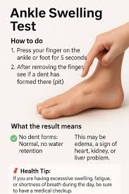 Image result for Edema Exam