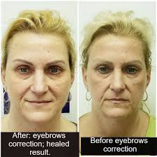 Woman left with 4 eyebrows after microblading treatment goes horribly wrong subscribe to informoverload Permanent Makeup Correction Eyebrows Tattoo Fix Cosmetic Tattoo Repair