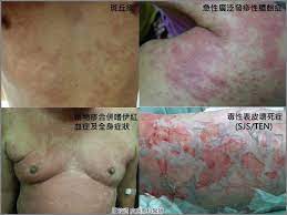 願麗 醫美診所 是 皮膚科 廖苑利 醫師創辦的 台北醫美 診所，包含 皮膚科 整形外科 門診，專精於 微整形 整形 雙眼皮 眼袋 醫美 杏仁酸 換膚 治療，擁有 皮秒 除斑 飛梭 雷射 海芙音波 電波拉皮 飛針 埋線 等專業技術 願麗 醫美診所 獲國家級肯定，是 專業 品質 服務 兼顧的 台北醫美 皮膚科. è—¥ç‰©éŽæ•å¯è¼•å¯é‡ æé«˜è­¦è¦ºåˆ¥å¤§æ„ ç…§è­·ç·šä¸Š