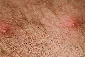 How poisonous are black widow spiders? Picture Of Lyme Disease Picture Image On Rxlist Com