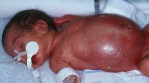 Image result for Necrotizing Enterocolitis