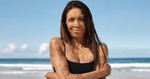 After suffering terrible burn injuries, turia was left with severe scaring on her face and body. Turia Pitt Shares Inspirational Message In Strong Sensitive Campaign From Avene Branding In Asia Magazine