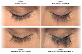 Do not ever apply it to the eyes or the lower lids / lash lines. Latisse