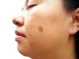 Image result for Freckled skin
