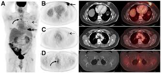 Pet/ct, which is a combination of positron emission tomography (pet) with computerized tomography (ct), is a powerful, essential tool for cancer detection and diagnosis. 18f Fdg Pet Ct For Systemic Staging Of Newly Diagnosed Breast Cancer In Men Journal Of Nuclear Medicine