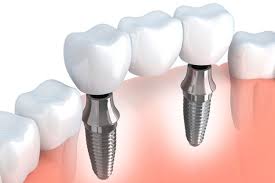 Dental implants are supposed to be matched with a patient's mouth and tooth structure. Implant Supported Bridges Kenilworth Il Skokie Il Wilmette Il