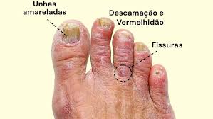 Doenças causadas por fungos: as 5 principais e seus agentes causadores -  Toda Matéria