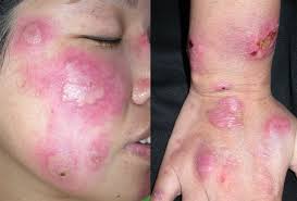 Sweet syndrome during pregnancy