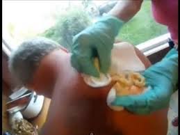 Cyst Extraction Huge Popped Gross Warning 331 Big Pimple Zits Zit Popping Videos