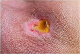Scabs will detach from the underlying skin fairly easily, and fairly quickly as the skin heals under it. Your Guide To Foam Wound Dressings Advanced Tissue