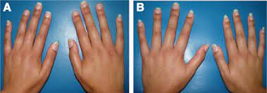 Poland syndrome is characterized by an underdeveloped or absent chest muscle on one side of the body, absence of the breastbone portion. Hands Of The Twin Girls At The Age Of 19 Years Hand Anomalies Are Not Download Scientific Diagram