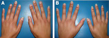 Poland syndrome is characterized by an underdeveloped or absent chest muscle on one side of the body, absence of the breastbone portion. Hands Of The Twin Girls At The Age Of 19 Years Hand Anomalies Are Not Download Scientific Diagram