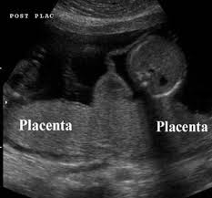Bilateral hilar and right paratracheal lymph nodes are typically involved which can resemble the greek letter lambda (λ). Pin On Obstetric Ultrasound