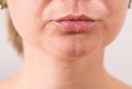 Medically, blood blisters in the mouth may be related to a condition known as angina bullosa hemorrhagica (abh). What Causes White Bumps On Lips How To Treat It