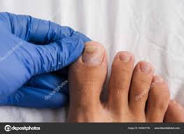 Image result for Onycholysis feet