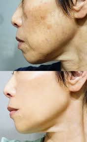 ビハククリア logly2 girls plus 顔のシミ 老け顔 顔のエクササイズ