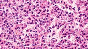 The plasma cells proliferate in the bone marrow and can. Fda Approves Abecma First Cell Based Gene Therapy For Multiple Myeloma