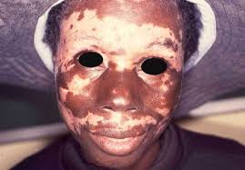 Image result for Vitiligo