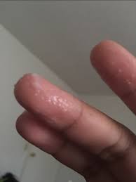 Signs you must look for to diagnose & treat yeast infection yeast infection looks like cottage cheese discharge which has a thick chunky curd like appearance. Yeast Infection Glow Community