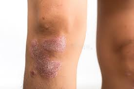 Image result for Anthralin