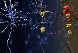 Failure to protect and enforce biogen's data, intellectual property, and other proprietary rights and uncertainties relating to intellectual property claims and challenges. Drug Scrubs Toxic Clumps From Alzheimer S Brains Cosmos Magazine