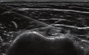 Image result for Biceps Tendon Injection