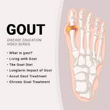 Gout In Knee Surgery Can Gout Lead To Arthritis Gout Treatment Gout How To Cure Gout