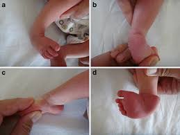Clubfoot, or talipes equinovarus, is a congenital deformity consisting of hindfoot equinus, hindfoot varus, and forefoot varus. Congenital Clubfoot Early Recognition And Conservative Management For Preventing Late Disabilities Springerlink