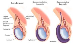 An increase in the firmness of a testicle. Urology Cryptorchidism Testicular Torsion Hydrocele Varicocele Flashcards Quizlet