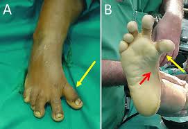 Image result for Hallux Varus