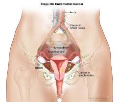 This can range from spotting to more heavy bleeds. Uterine Cancer General Information Symptoms Signs Of Endometrial Cancer Cleveland Oh University Hospitals