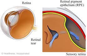 The aim of retinal detachment surgery is to 'glue' the neurosensory retina back where to it is meant to be positioned. Surgery For Retinal Detachment What To Expect At Home